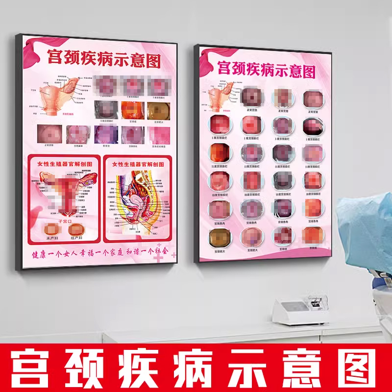女性泌尿生殖系统结构宫颈疾病妇科解刨示意图挂图墙贴画健康宣传