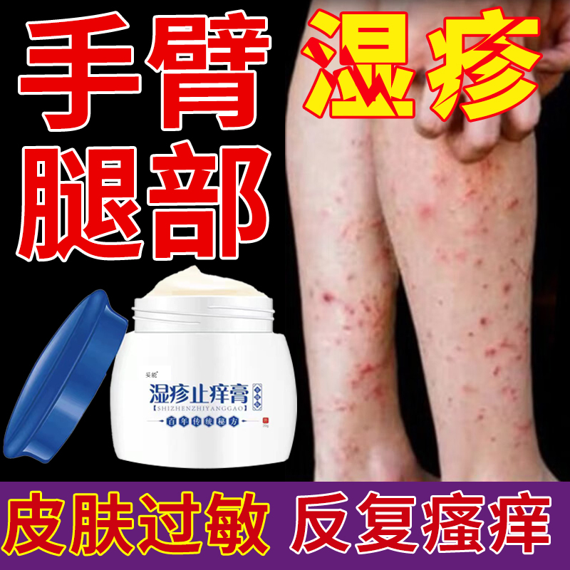 手臂腿部皮肤水泡湿疹可搭配止痒膏外用去顽固皮炎寻荨麻疹瘙痒CJ
