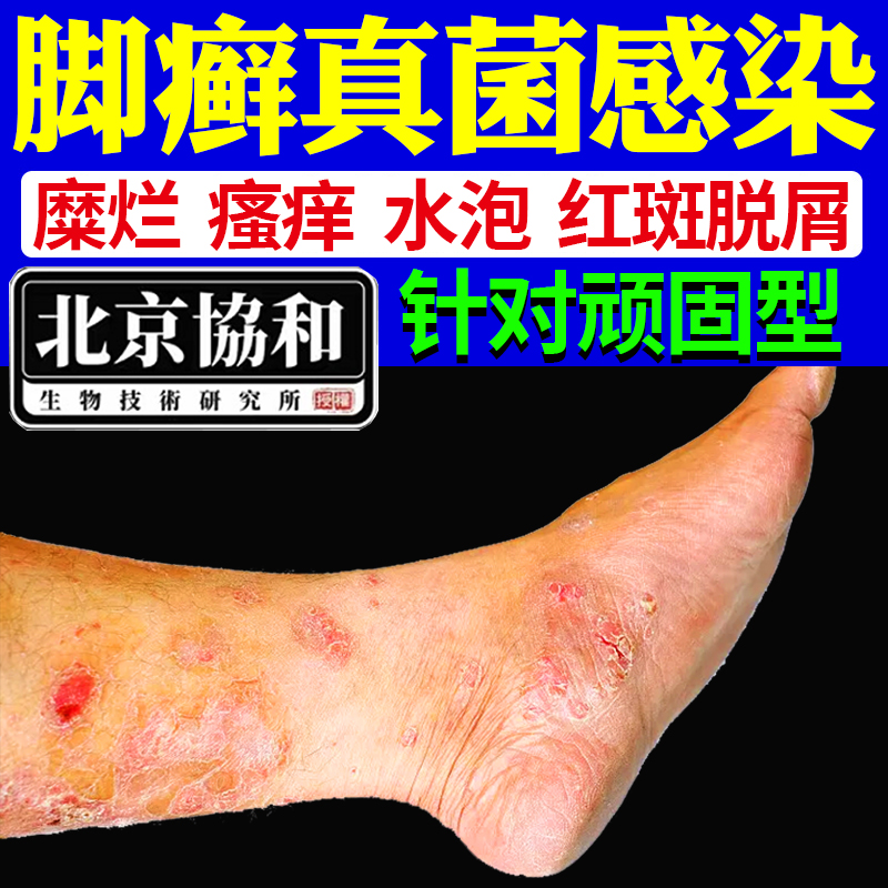 脚癣一次净泡脚喷剂脚气去止痒脚底脚藓真菌感染根湿疹足癣藓wl