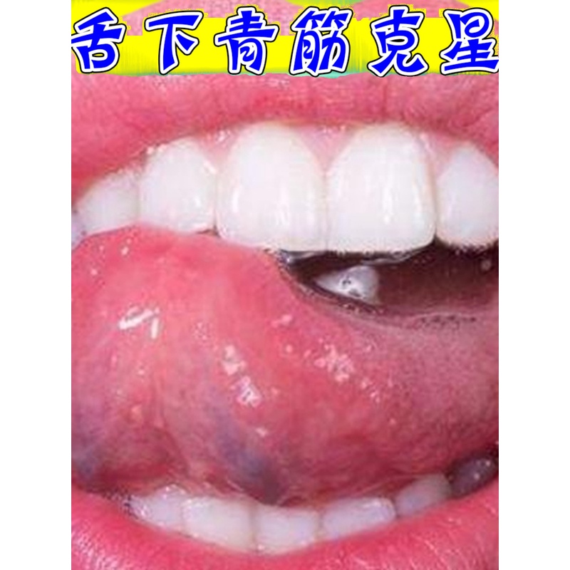 舌下青筋舌头底部血管怒张血液不流通虚弱舌下血管凸起专用溶栓剂