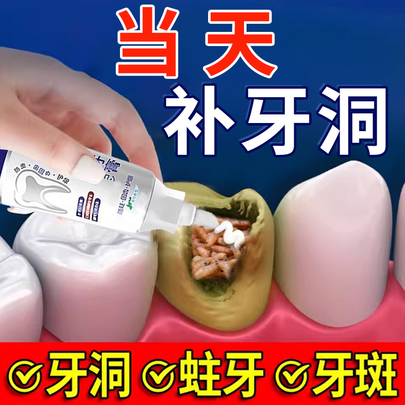仲景堂【101%补牙】蛀牙牙洞清理龋齿自己补专用牙膏儿童防蛀牙齿