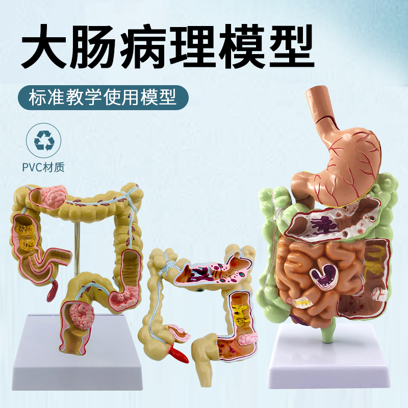 胃剖面模型 人体正常胃解剖 病变胃部疾病演示 病理大肠结肠模型