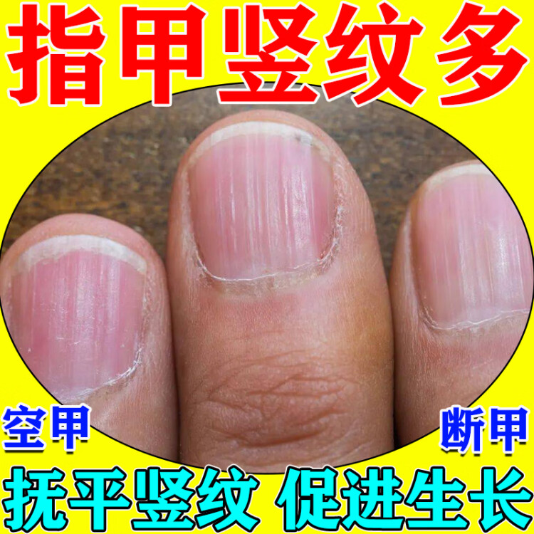 指甲有竖纹修复吃什么药指甲修复液受损再生手脚甲凹凸不平分层裂