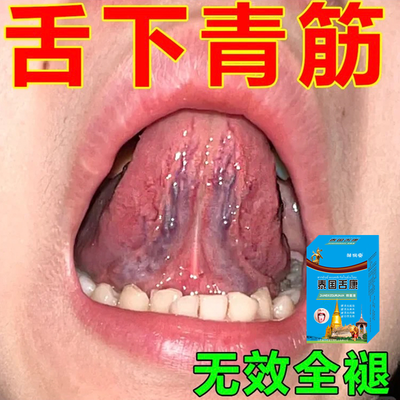 舌下青筋又黑又粗淤血疏通舌头底血管怒张严重紧挨舌下溶栓喷雾剂