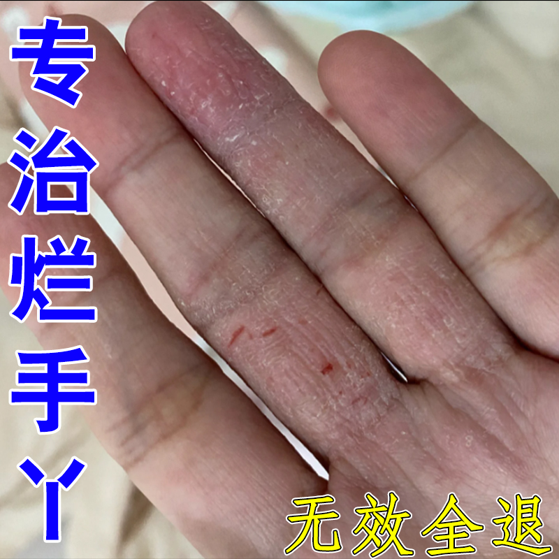 手指缝烂痒专用药手掌长藓药膏真菌感染烂手溃烂发红脱皮瘙痒药膏