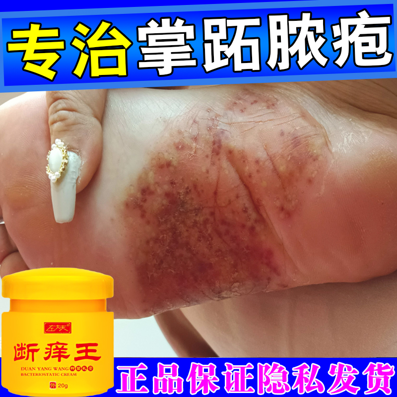 掌跖脓疱病手脚真菌感染干裂脱皮手足癣专用药治疗手掌红斑脓包药