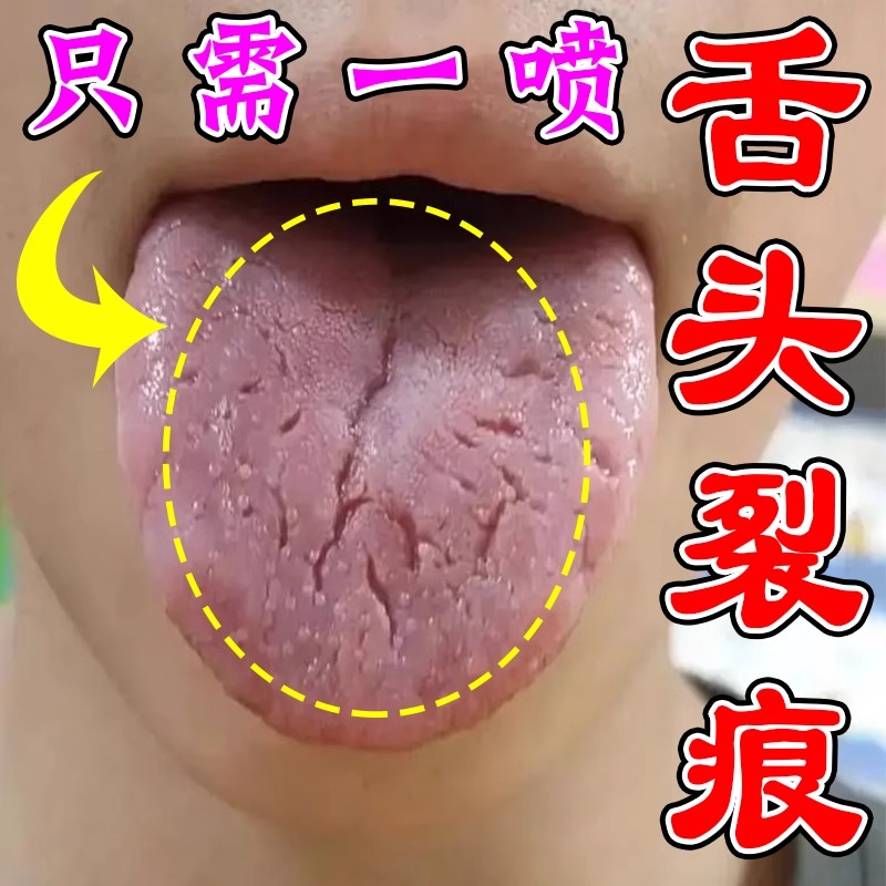 舌头有裂纹专用喷剂治舌头开裂发炎脾胃虚弱舌面发白发厚麻木起泡