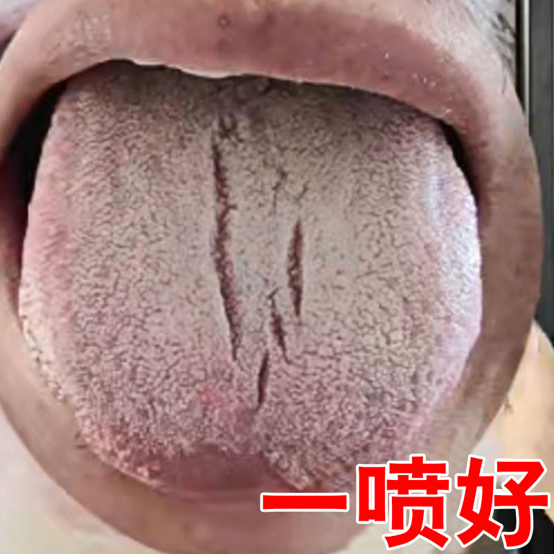 舌头裂痕地图舌裂纹舌齿痕麻木起泡疼舌头发白发厚灼口综合症喷剂