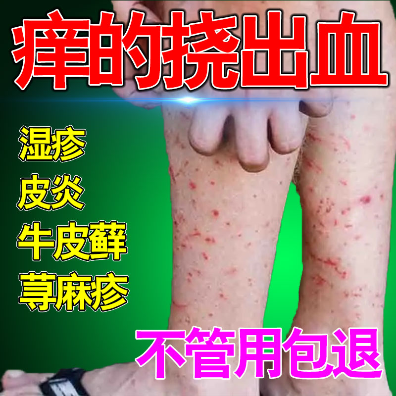 湿疹过敏性皮炎止痒消肿皮肤瘙痒抑菌顽固皮疹红疹皮肤病外用药膏