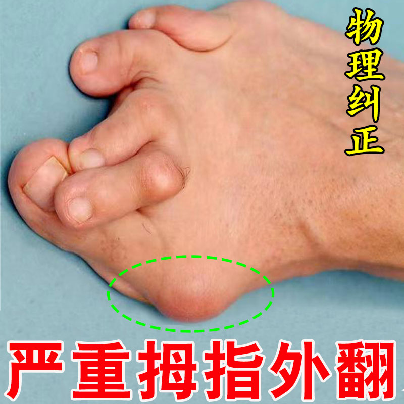 拇指外翻药膏贴大脚骨矫正器脚趾疼痛畸形肿胀突出专用防磨神器