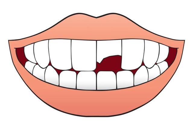速发修补牙缝牙套子修饰牙缝牙齿补充牙不齐贴补漏稀牙怎么办神器