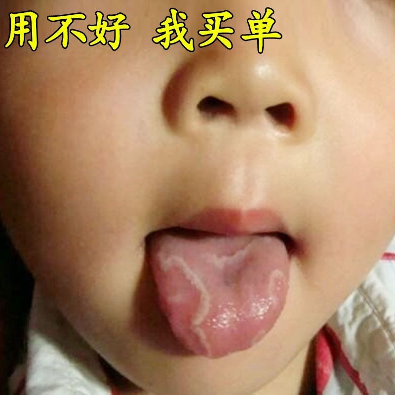 【儿童地图舌】地图舌喷剂大人小孩专用舌头不规则斑块剥脱性舌炎