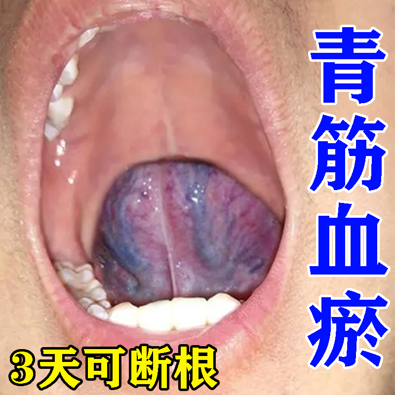 舌头下青筋