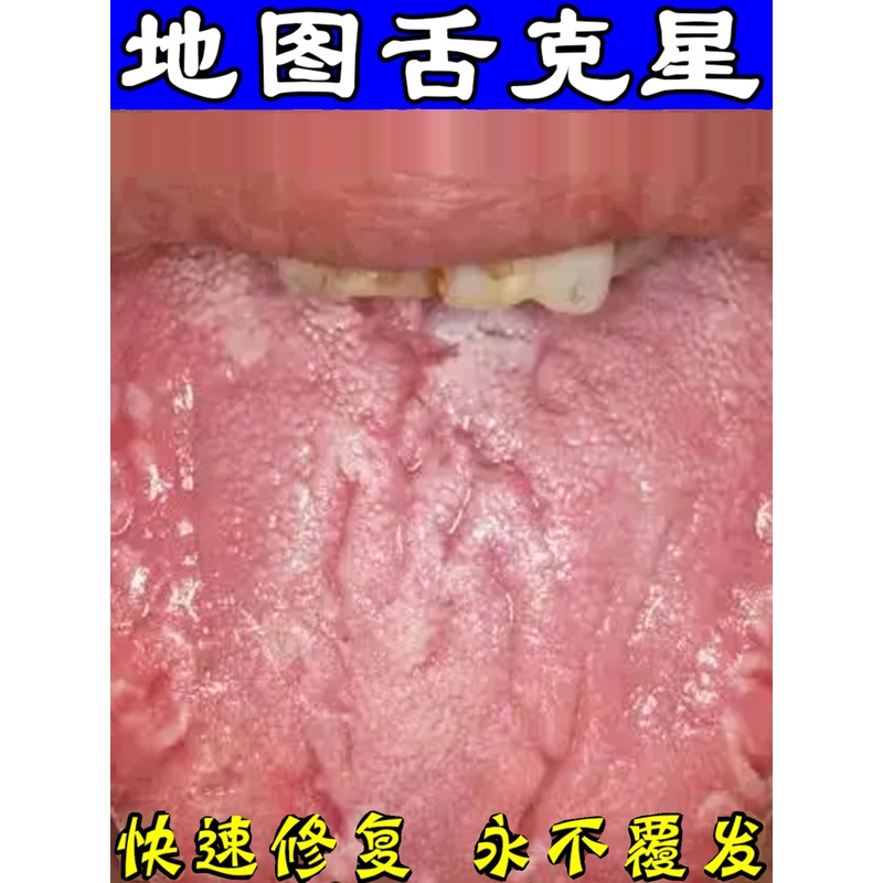 舌苔裂纹