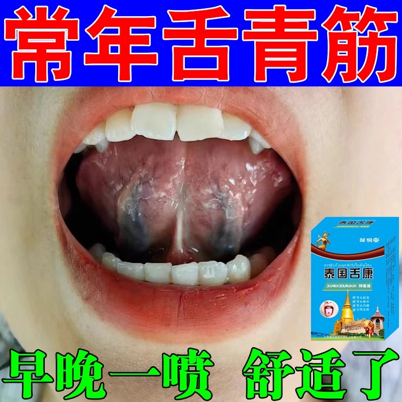 消除舌下青筋又黑又粗舌下有淤血管怒张疏通舌头底下血管草本喷剂