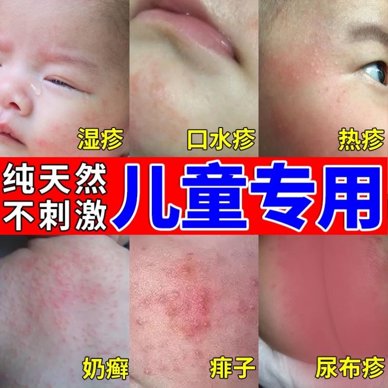 湿疹膏婴儿专用治疗宝宝幼儿脸上红热疹干性奶癣纽强无激素身体乳