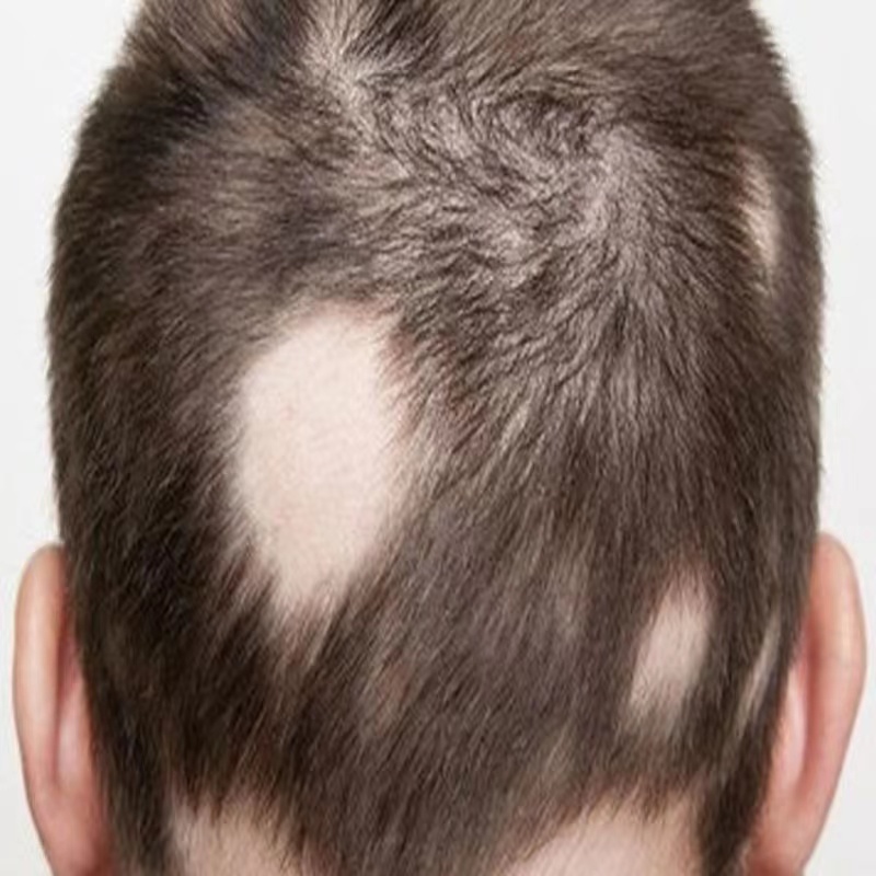 速发头部背面出现大小块光秃没长头发强效修复去斑秃鬼剃发克星第