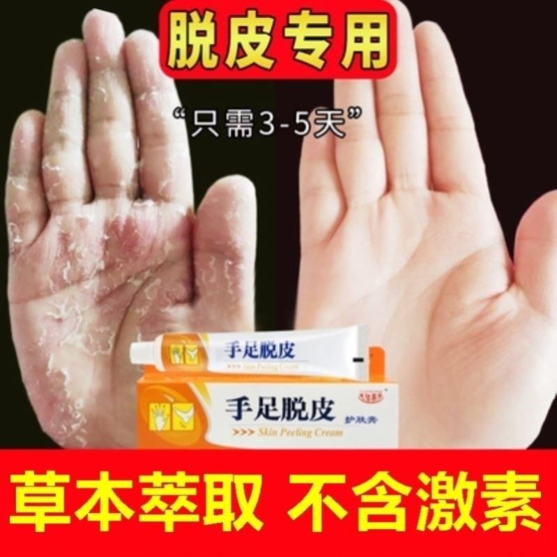 手脱皮的药膏儿童成人手指真菌感染手脚干裂蜕皮干燥起皮软膏