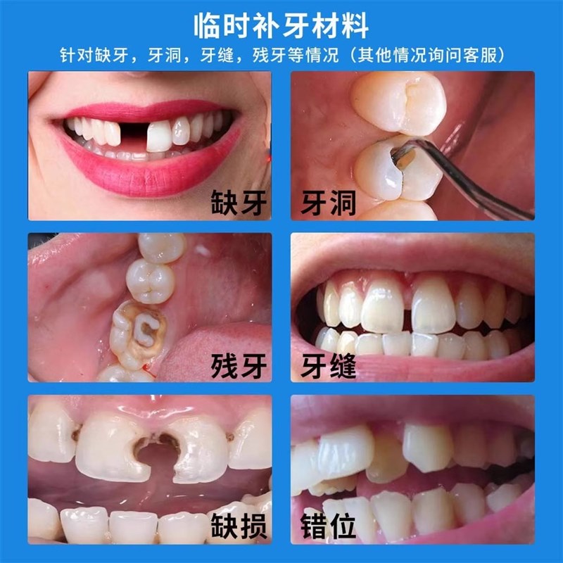 推荐补牙神器自己在家补牙齿缝洞材料永久树脂儿童修复蛀牙洞牙填