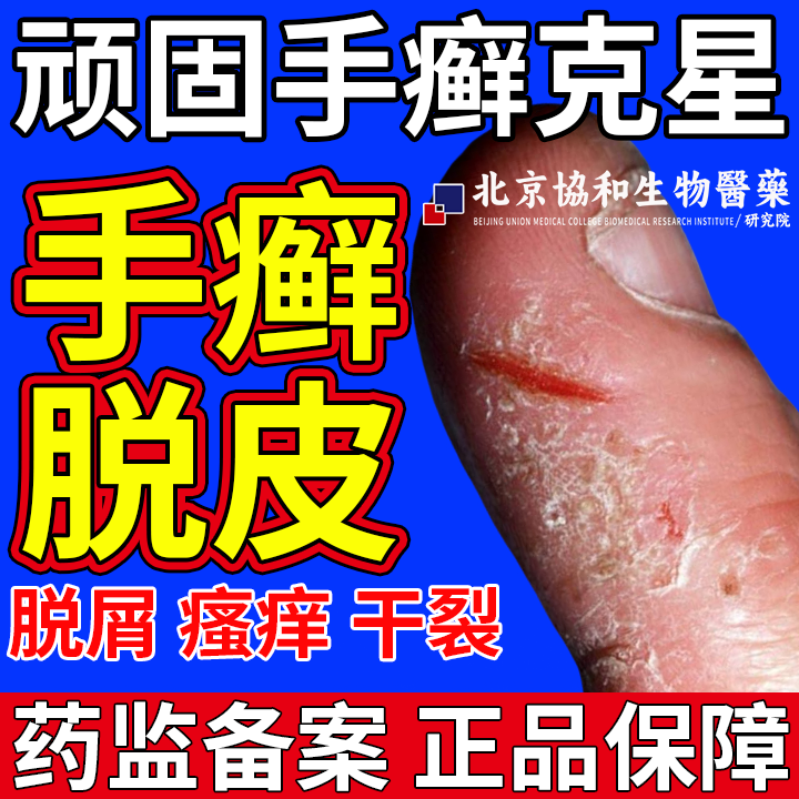 手癣膏脱皮干裂真菌感染湿疹去止痒根专用鹅掌风足癣薬房同款膏OZ