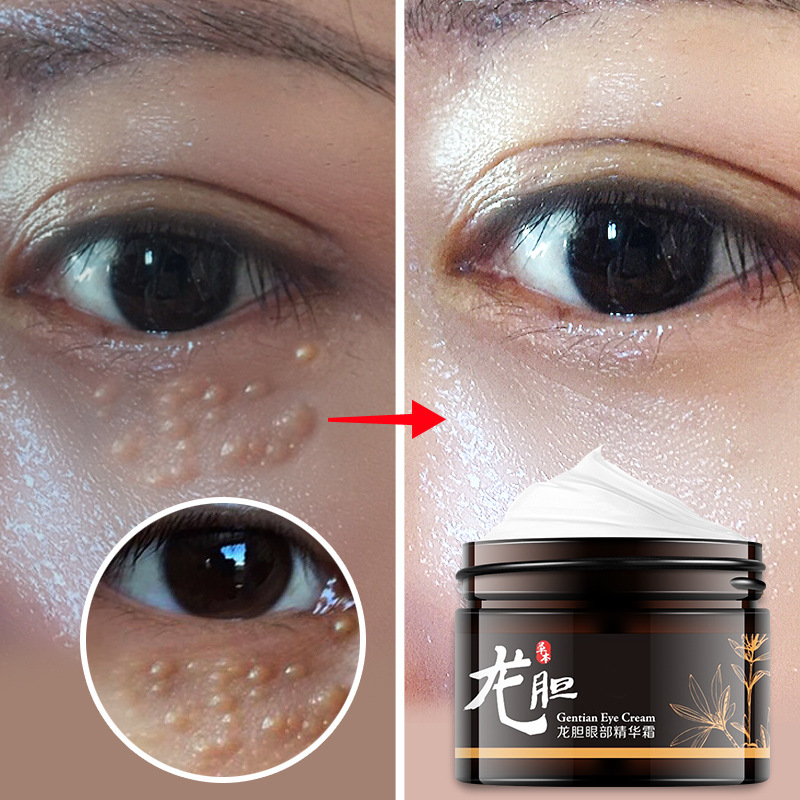 眼皮上的去眼下眼睑去脂肪粒眼霜30g祛脂肪粒上眼皮脂去眼部告别
