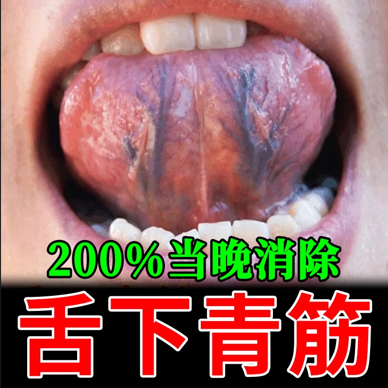 舌下青筋专用喷剂又黑又粗大淤血疏通舌头底冷黑紫血管严重怒张LJ