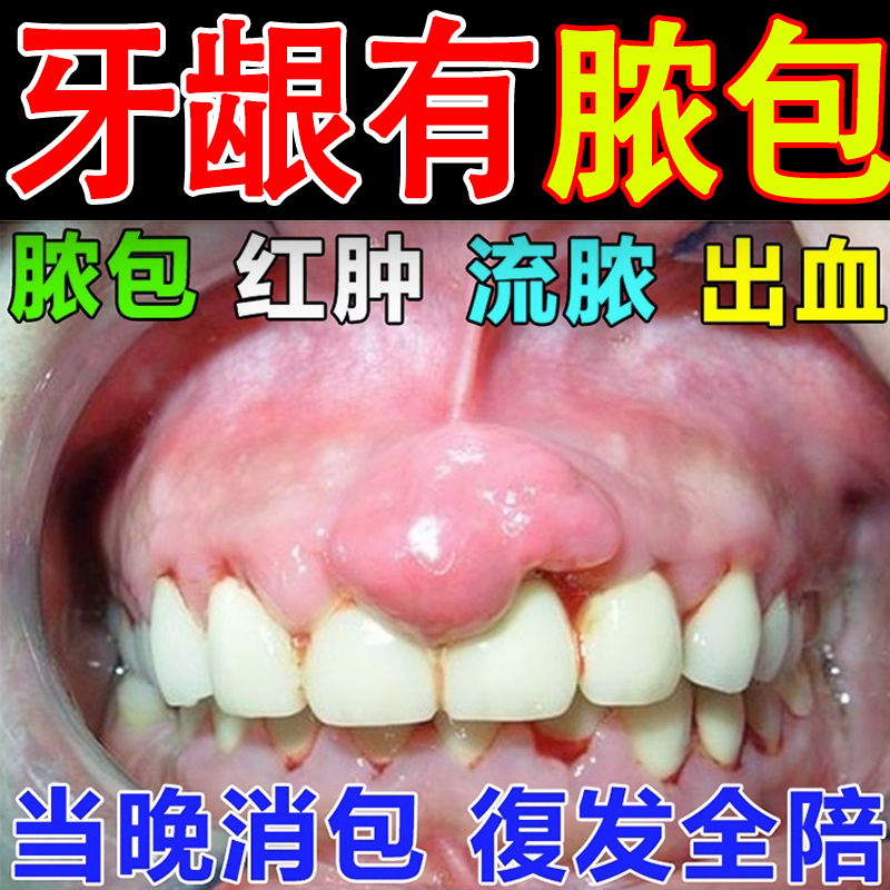 牙龈脓包牙根发炎肿包肿痛消炎牙根鼓包上火牙根周炎止痛喷剂药