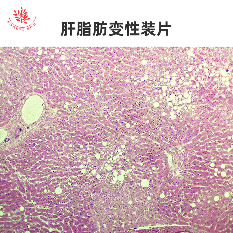 肉芽肿性炎装片肝脂肪变性装片人体病理组织高教教学用显微镜玻片