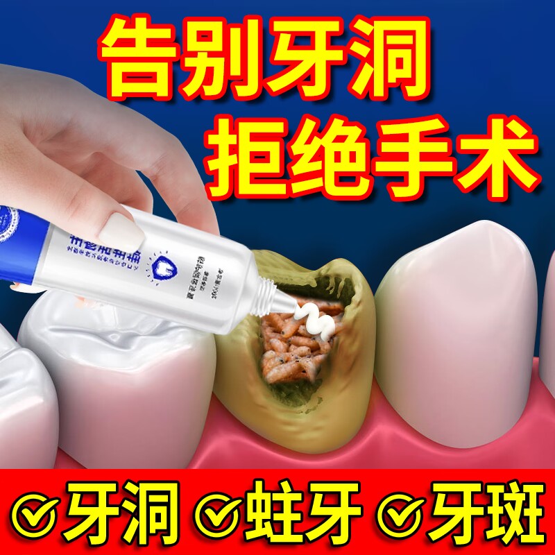 补牙齿洞膏补牙膏缝修复蛀牙烂牙自己在家补牙填牙洞填充清理神器