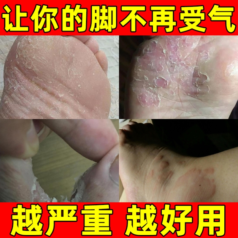 脚底真菌感染擦汗疱疹手脚真菌感染癣克星专用治疗藓药膏真菌感染