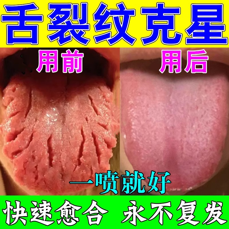 地图舌裂纹舌尖发麻舌头肥大齿痕舌神器舌苔发白厚黄起泡刺痛喷剂