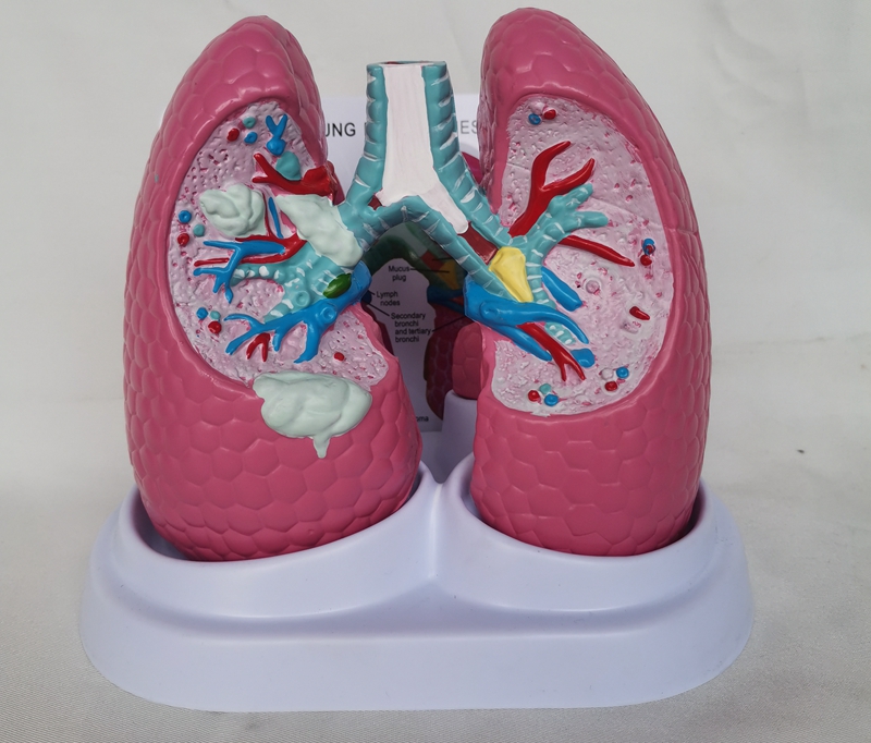 人体肺部病理解剖展示模型 内脏结构演示 医用教学医患讲解