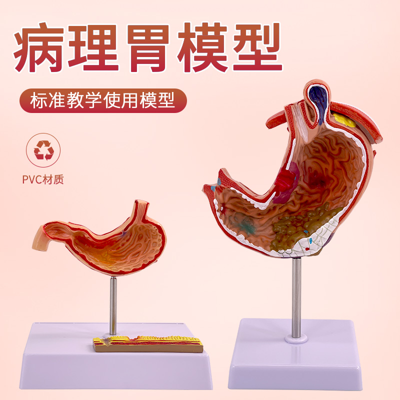 人体胃解剖模型 胃的病变模型 胃部疾病演示模型 病理胃 胃的穿孔