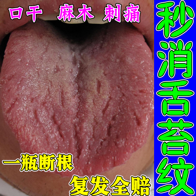 舌苔裂纹