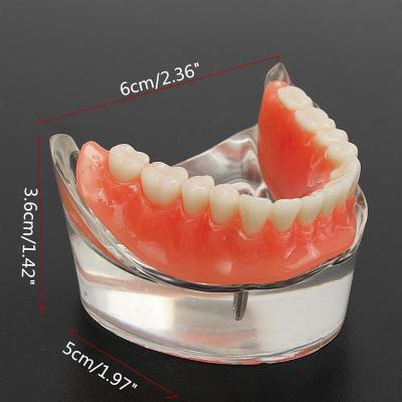 牙科覆盖义齿2钉颌下牙种植 修复模型牙科口腔教学模型假牙可拆卸