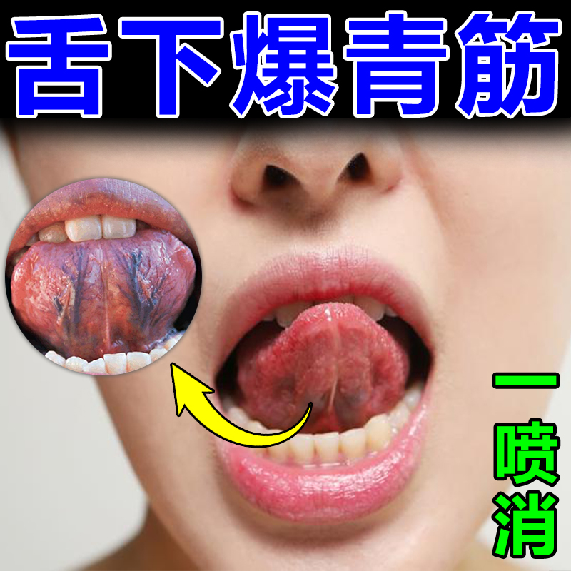 舌下青筋又黑又粗舌头底血管严重怒张血管突起舌淤血疏通专用喷剂