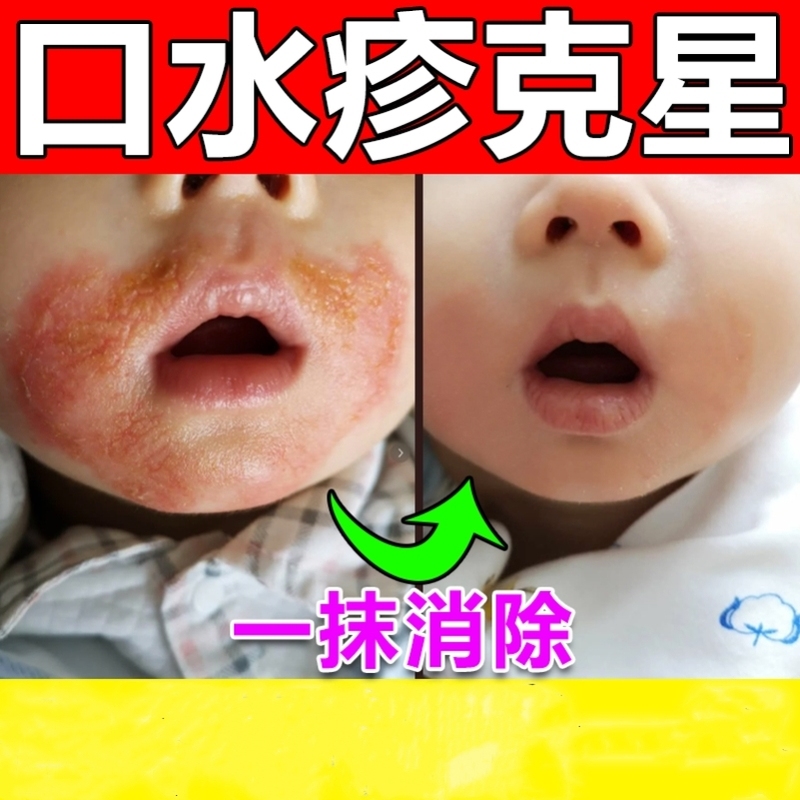 口水疹膏婴儿宝宝专用预防初宝唇周口水修护神器冬季润本面霜药膏