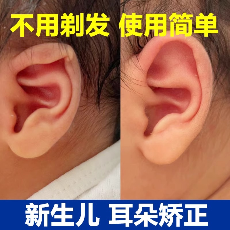 新生儿耳朵矫正器婴儿耳廓贴耳畸形纠正塑形外耳垂定型招风耳宝宝