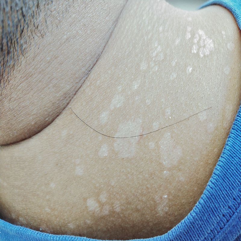 脖子长白斑汗斑皮肤油脂过多真菌感染脸颊上汗斑花斑癣大量出汗