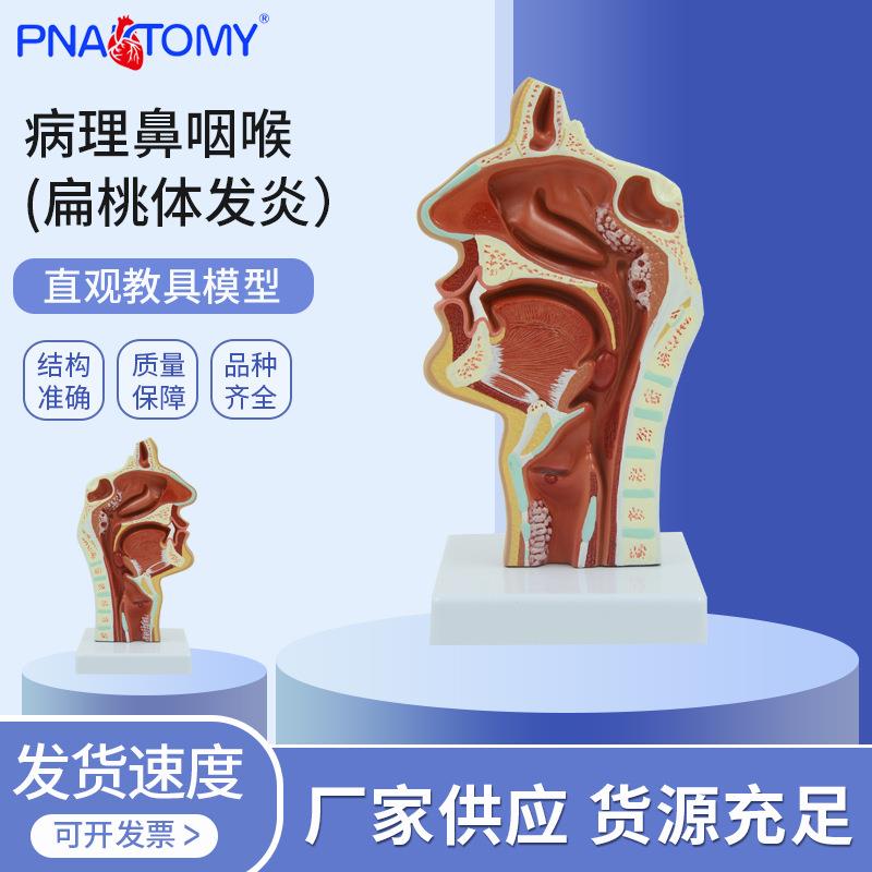 PNT-0736人体鼻腔咽喉解剖教学模型 病理鼻咽喉（扁桃体发炎）