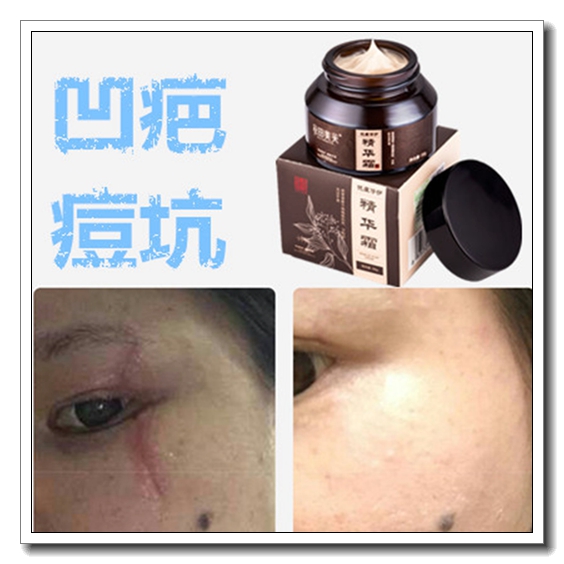 修复激光伤口祛凹陷疤痕痘印痘坑前五强淡化痘疤去日本黑皮肤软膏