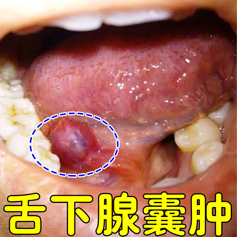舌下腺囊肿专用喷剂舌根长疙瘩肿块有异物感口腔粘液腺囊肿息肉