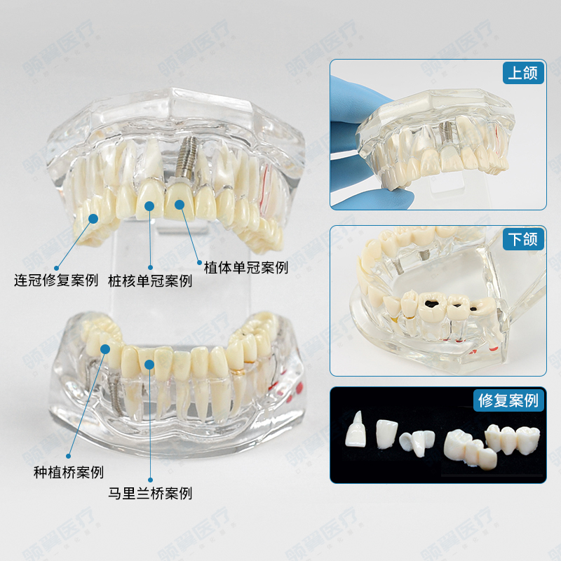 种植牙模型模具综合修复蛀牙全口牙齿模型口腔教学生诊所摆件智齿