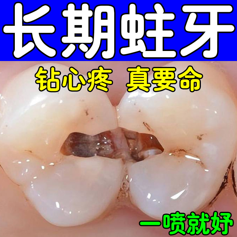 蛀牙龋齿修复虫牙烂牙牙洞牙齿黑窟窿儿童蛀牙牙痛牙菌斑黑线专用