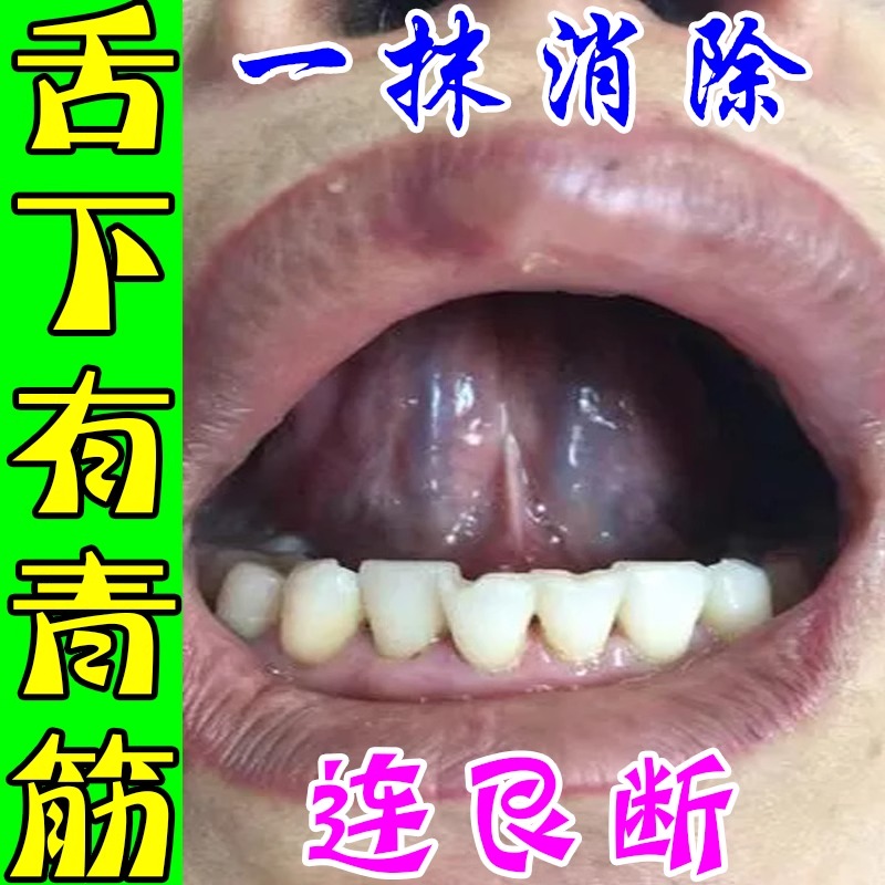 舌下青筋专用口腔溶栓喷剂静脉变粗血液不流通肿胀舌头底血管怒张