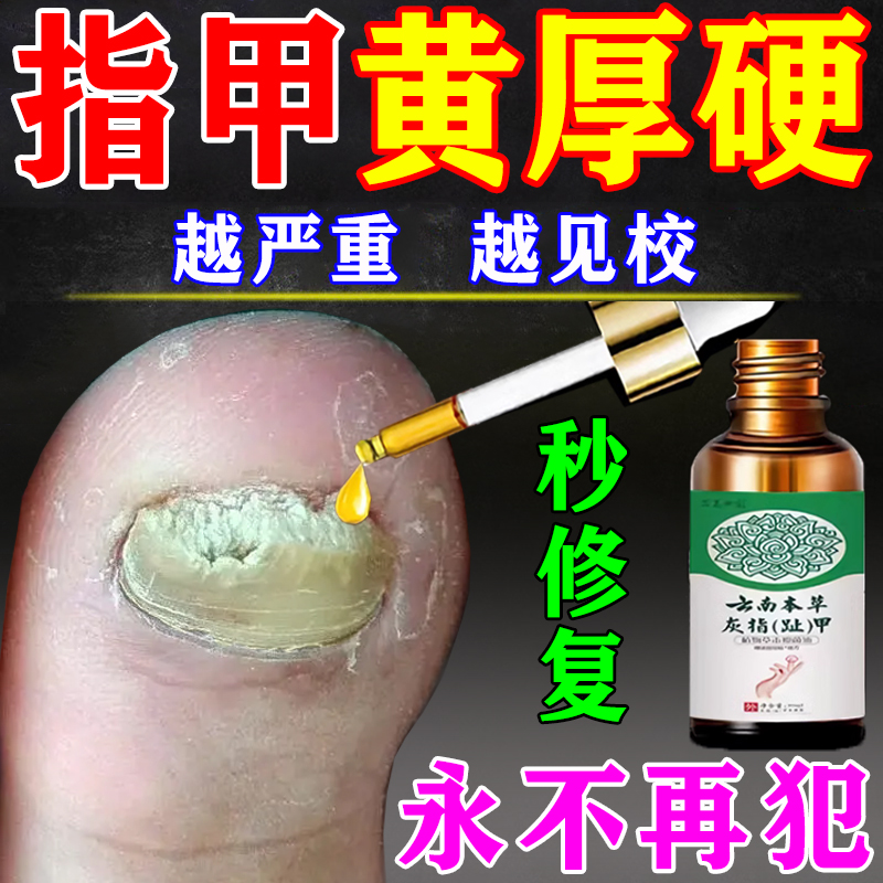 脚指甲发黄变厚增厚变硬真菌性白甲空甲床分离修复灰甲治疗专用药