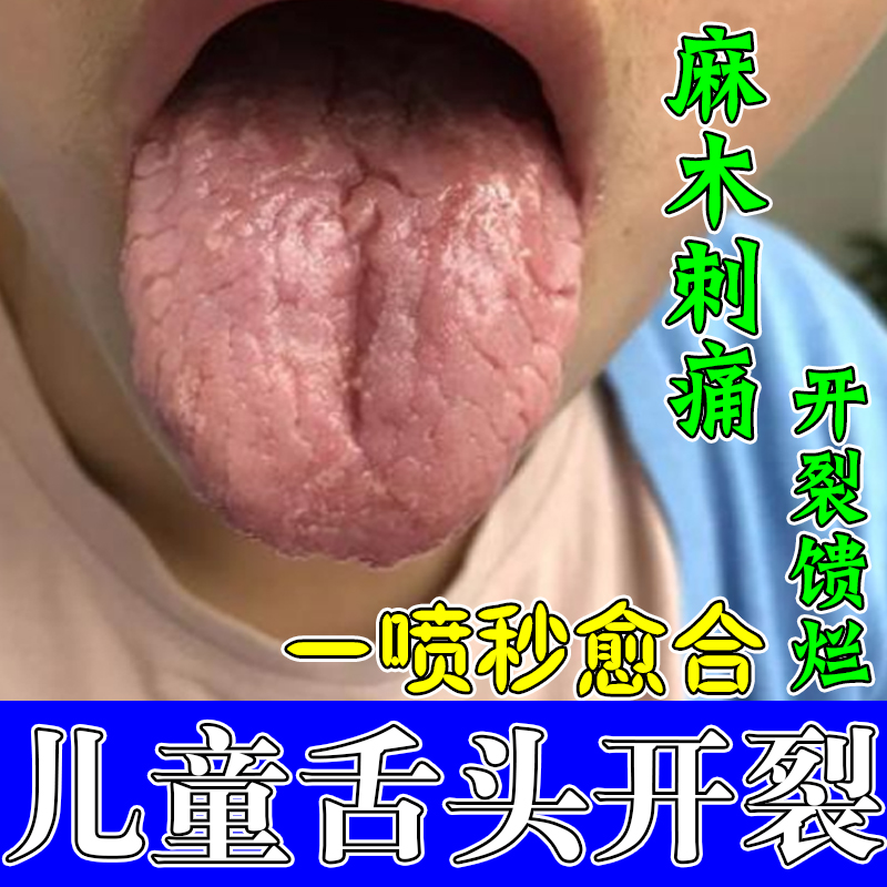 舌头裂纹齿痕舌舌沟纹调理灼口综合症舌苔白厚开裂麻木抑菌修复药