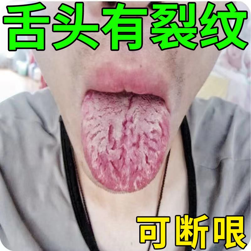 舌头裂痕冶舌头有裂纹地图舌齿痕灼口综合症舌苔白厚麻木起泡专用