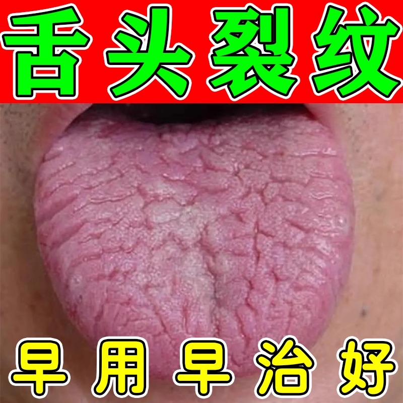 舌头中间有裂纹地图舌调理儿童舌头发白发厚麻木灼痛起水泡抑菌液