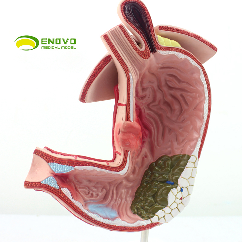 ENOVO颐诺医学胃部疾病演示模型 胃病模型 人体胃解剖消化系统模